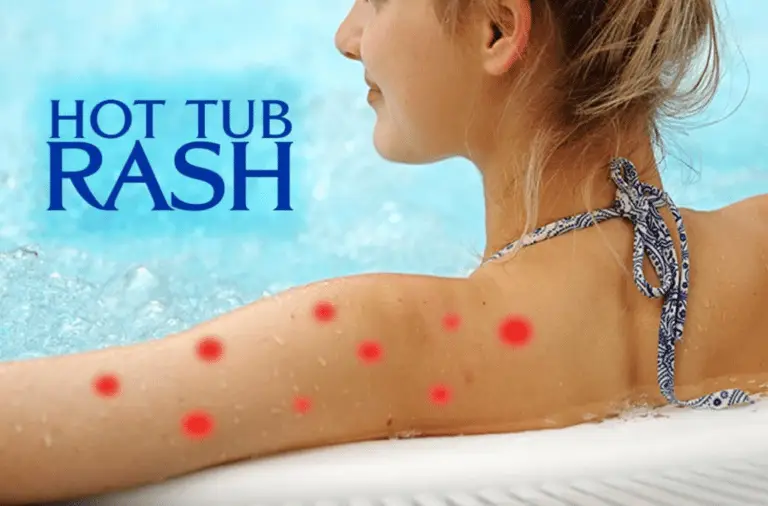 Hot tub rash image with a woman with a red rash sitting in a hot tub.